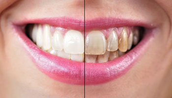 dentist whitening before after