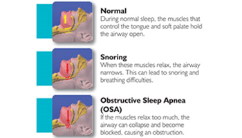 Sleep Apnea Diagram
