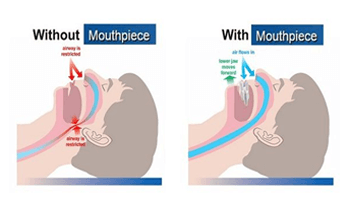 Night time breathing with and without a moutpiece